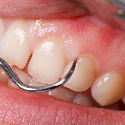 Periodontitis- Clínica dental Belén Pérez