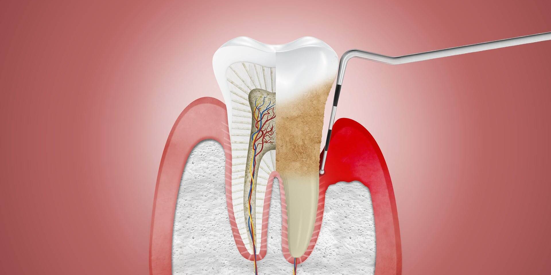 Tratamiento de periodontitis en la clínica dental Belén Pérez en Getxo