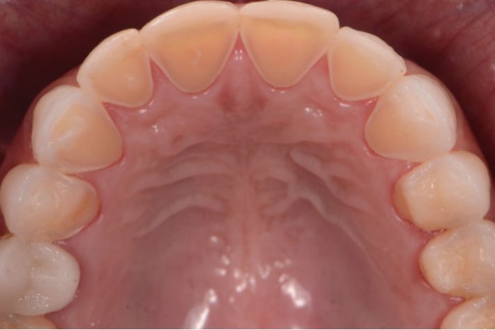 ¿Qué es la erosión dental?