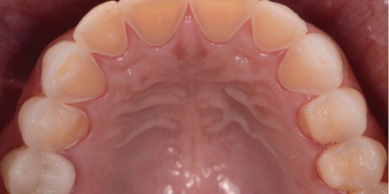 ¿Qué es la erosión dental?