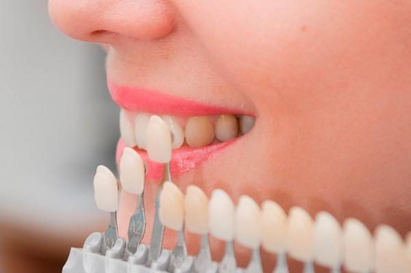 Distintas carillas dentales en un blanqueamiento - Belén Pérez, clínica dental Getxo