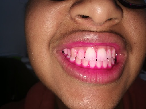 dientes con reveladores de placa