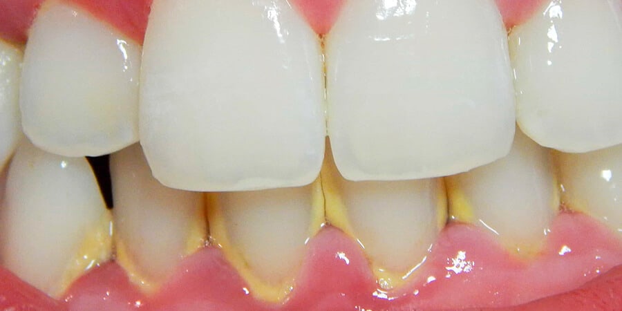 Consejos para prevenir la placa y eliminar el sarro dental