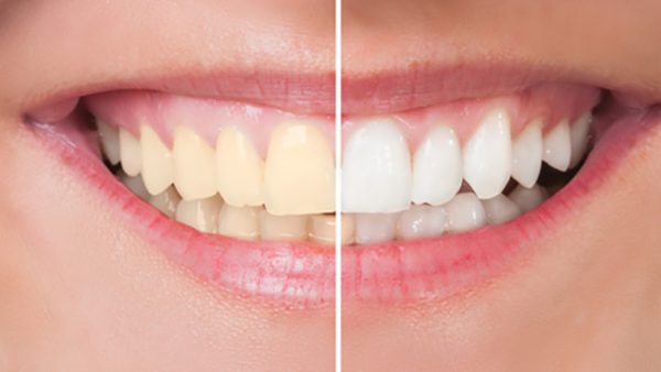 qué son los dientes oscurecidos