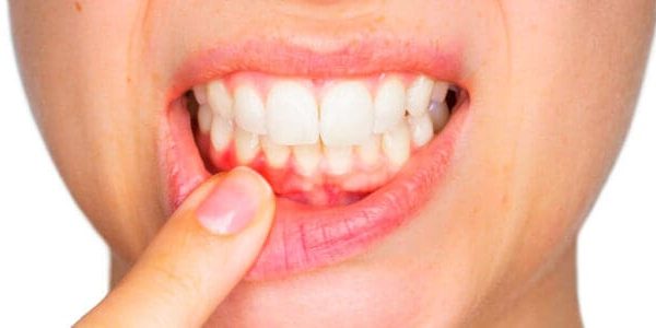 Diferencia entre periodontitis y gingivitis - Belén Pérez, clínica dental en Getxo