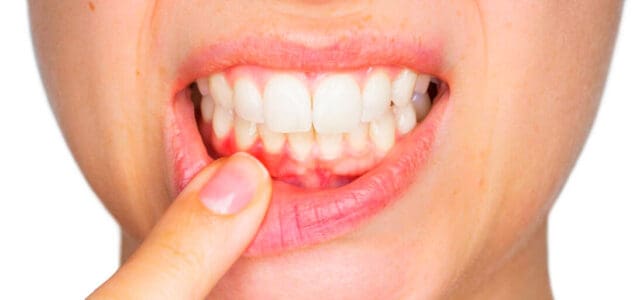 Gingivitis: sensibilidad dental - Belén Pérez, dentista Getxo