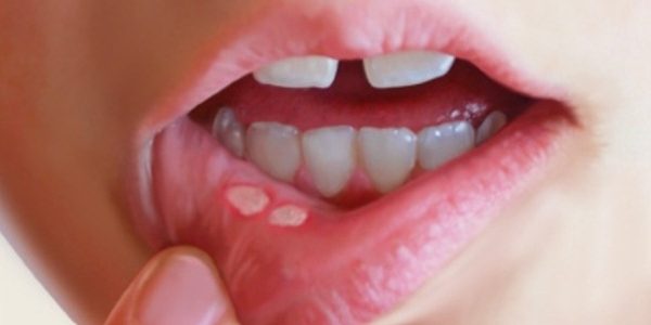 Remedios caseros para eliminar llagas en la lengua fácilmente