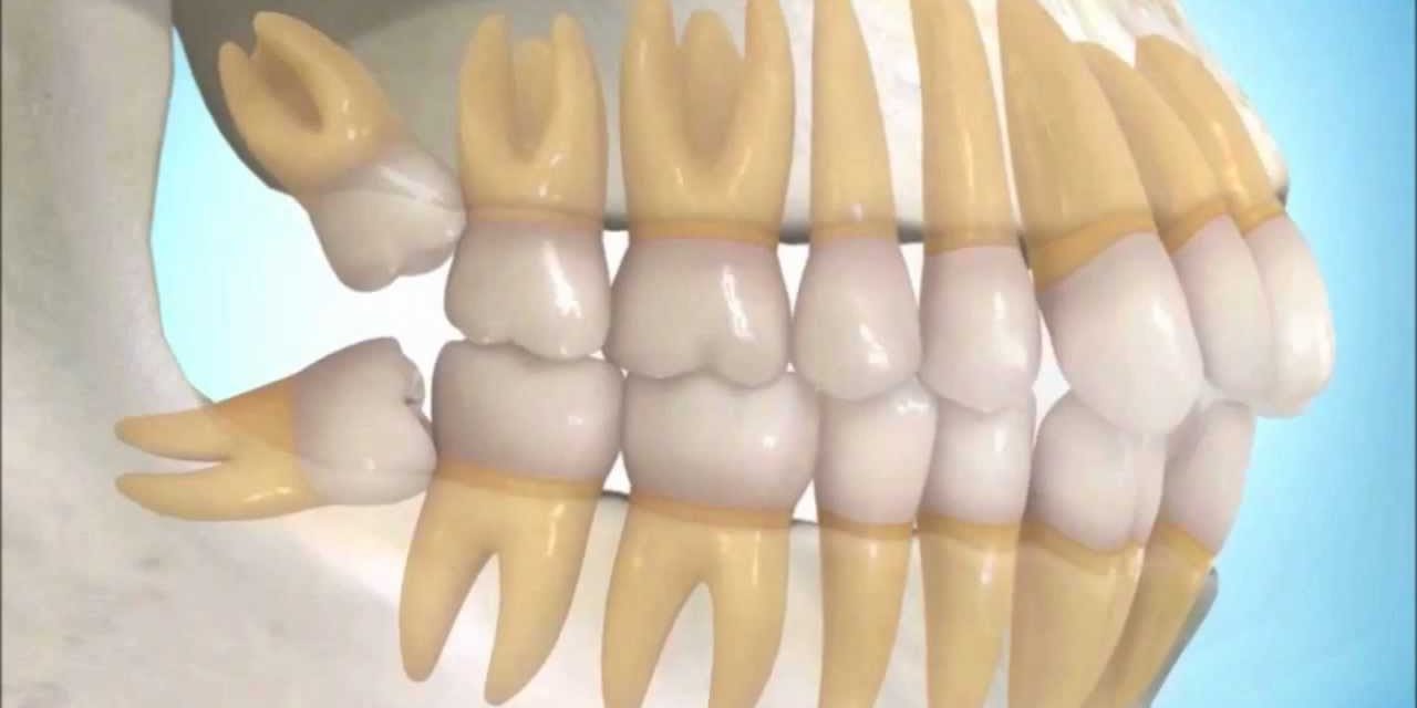 Muelas del juicio retenidas - Clínica dental en Getxo, BP
