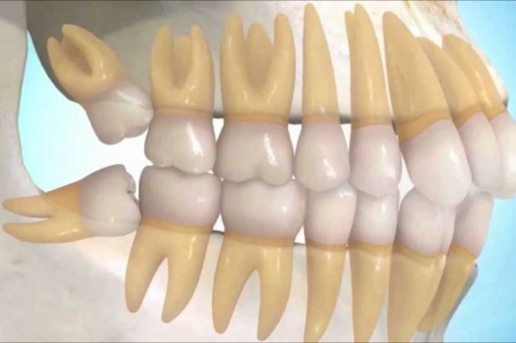 Muelas del juicio retenidas - Clínica dental en Getxo, BP