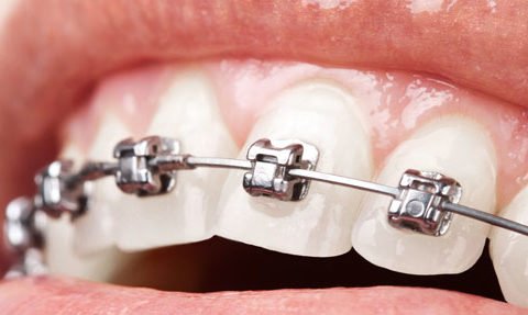 La ortodoncia de baja fricción es uno de los tipos de brackets que usamos en Belén Pérez Dental