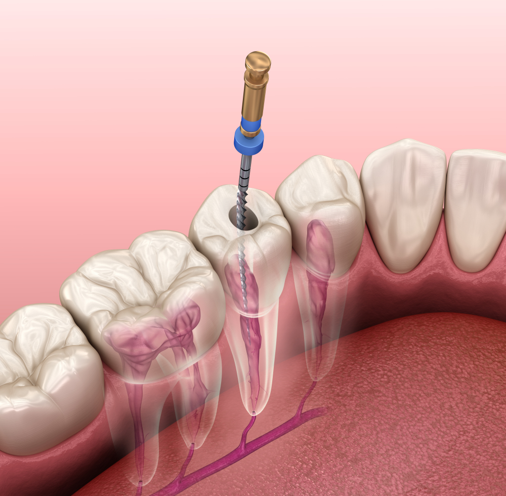 Tratamiento flemon dental - endodoncia belen perez dental