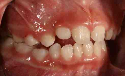 Anquilosis dental