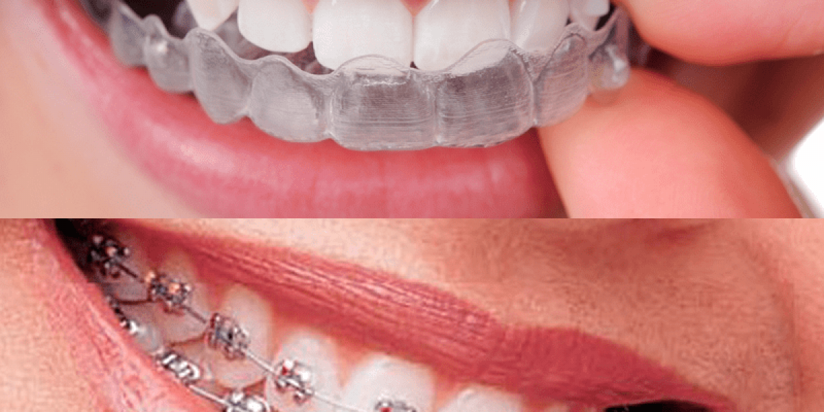 Ortodoncia invisible y brackets