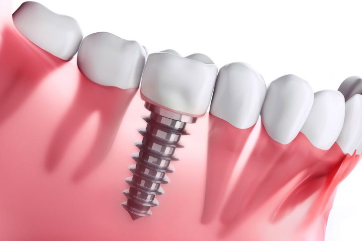 Implantes dentales Getxo - Belén Pérez
