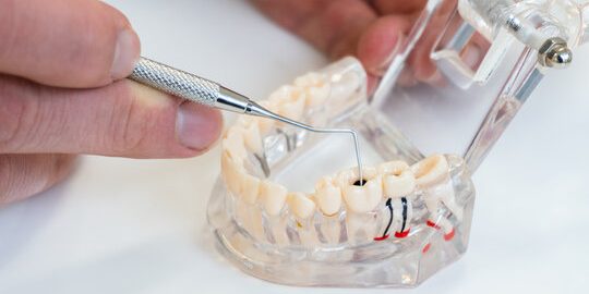 pulpitis reversible - Dentistas Getxo Belen Perez